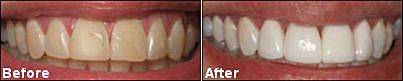 Before and after photo of teeth.