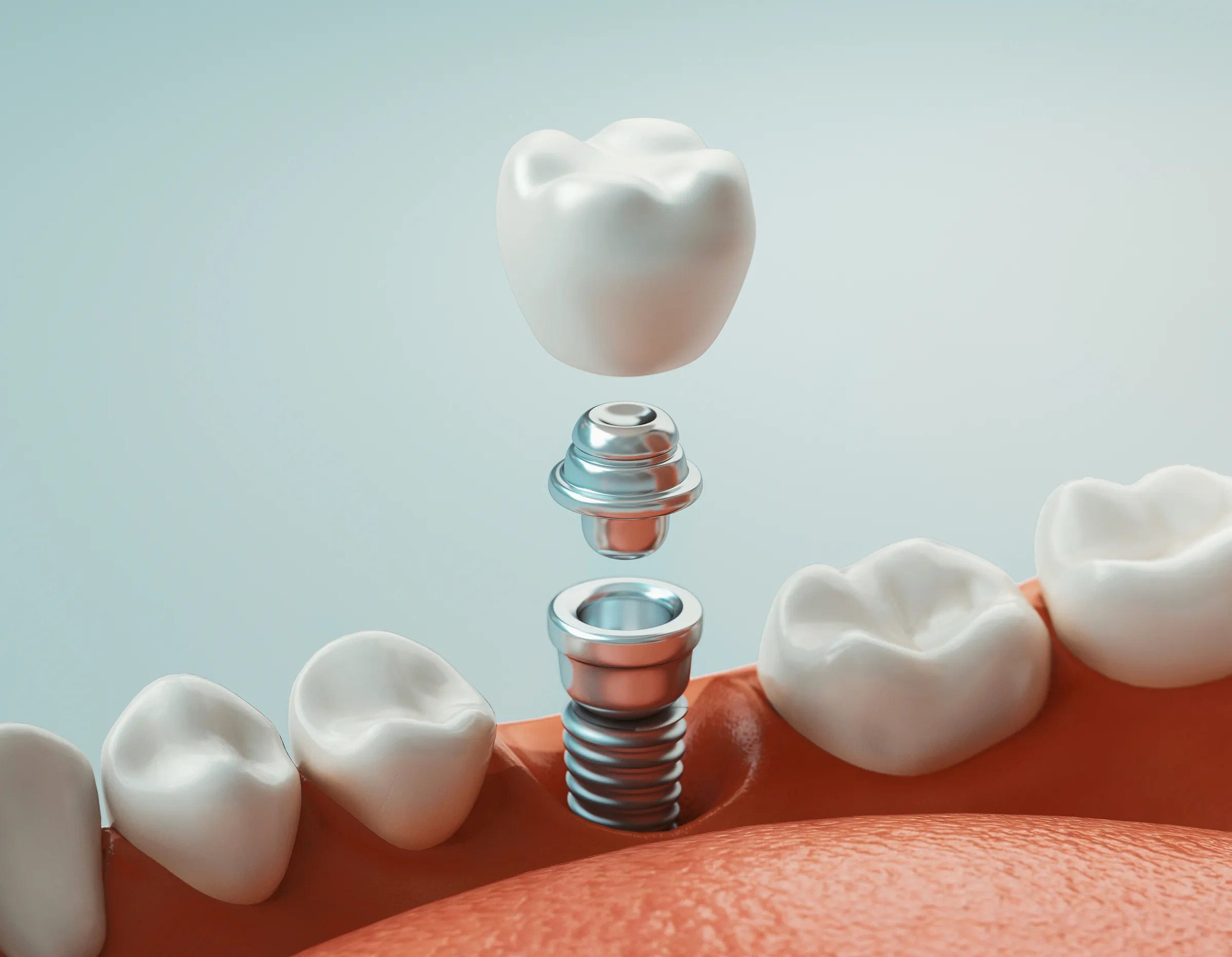 A natural-looking dental implant restoration