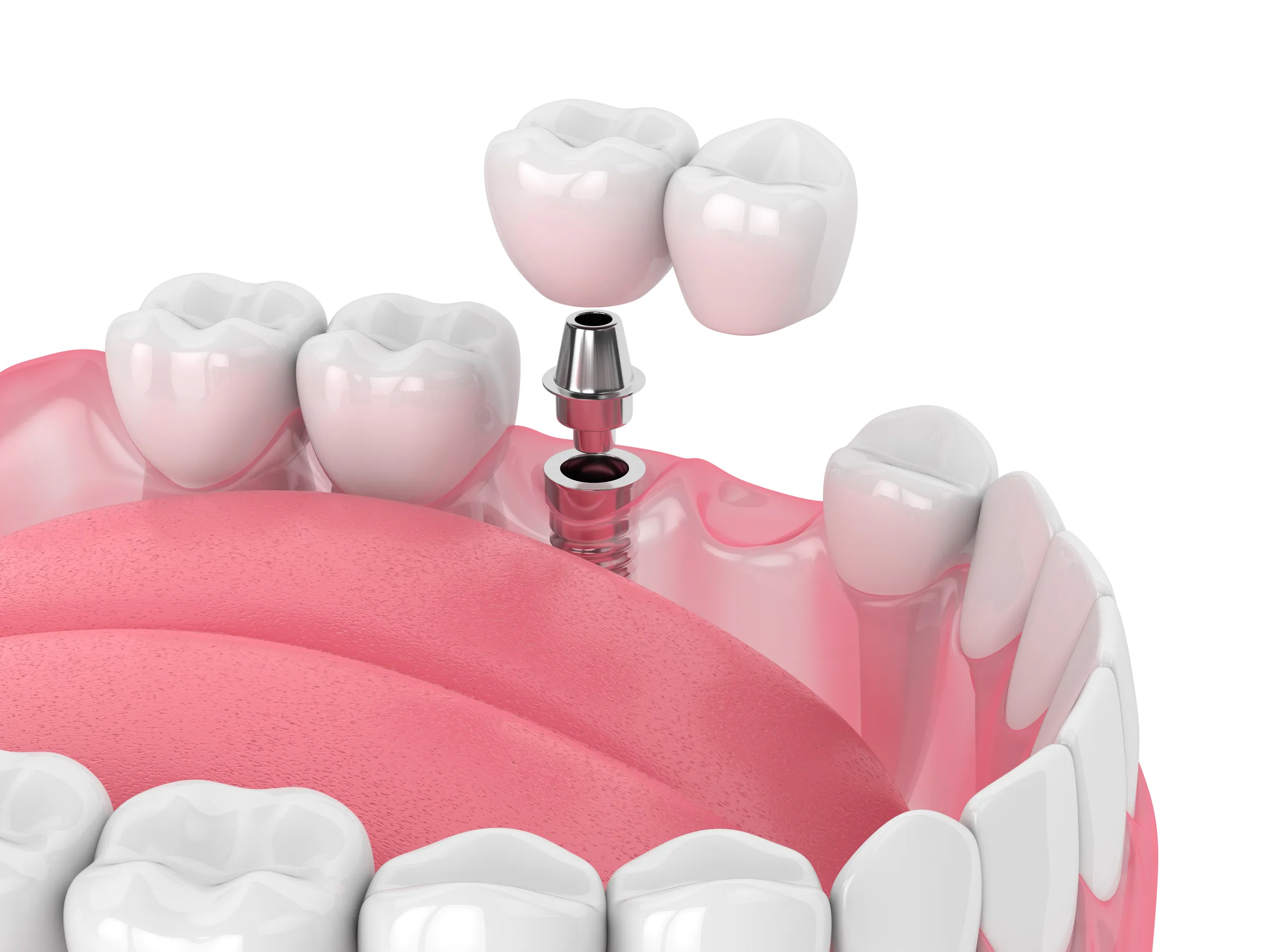 A patient consultation about dental implants