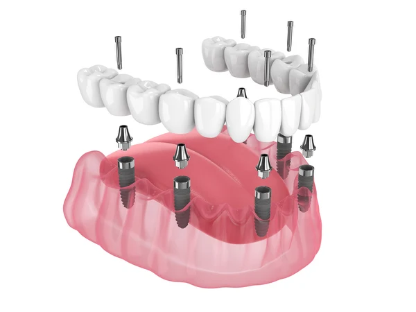 Full-arch implant restoration