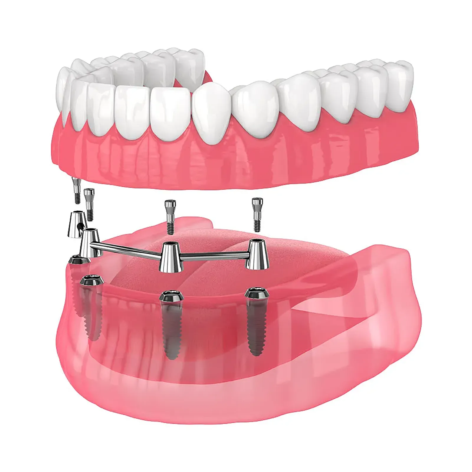 Implant-supported denture