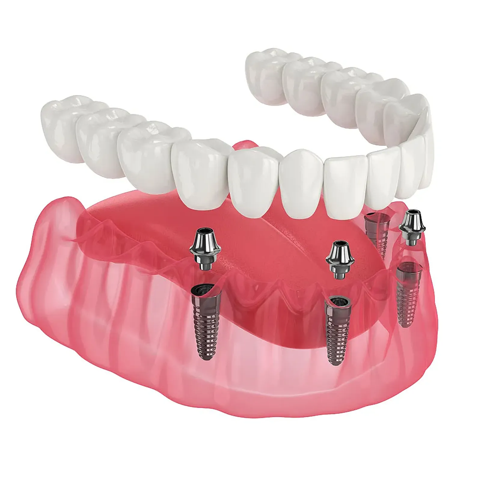 Full-arch implant restoration