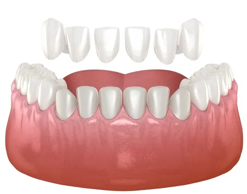 Veneers