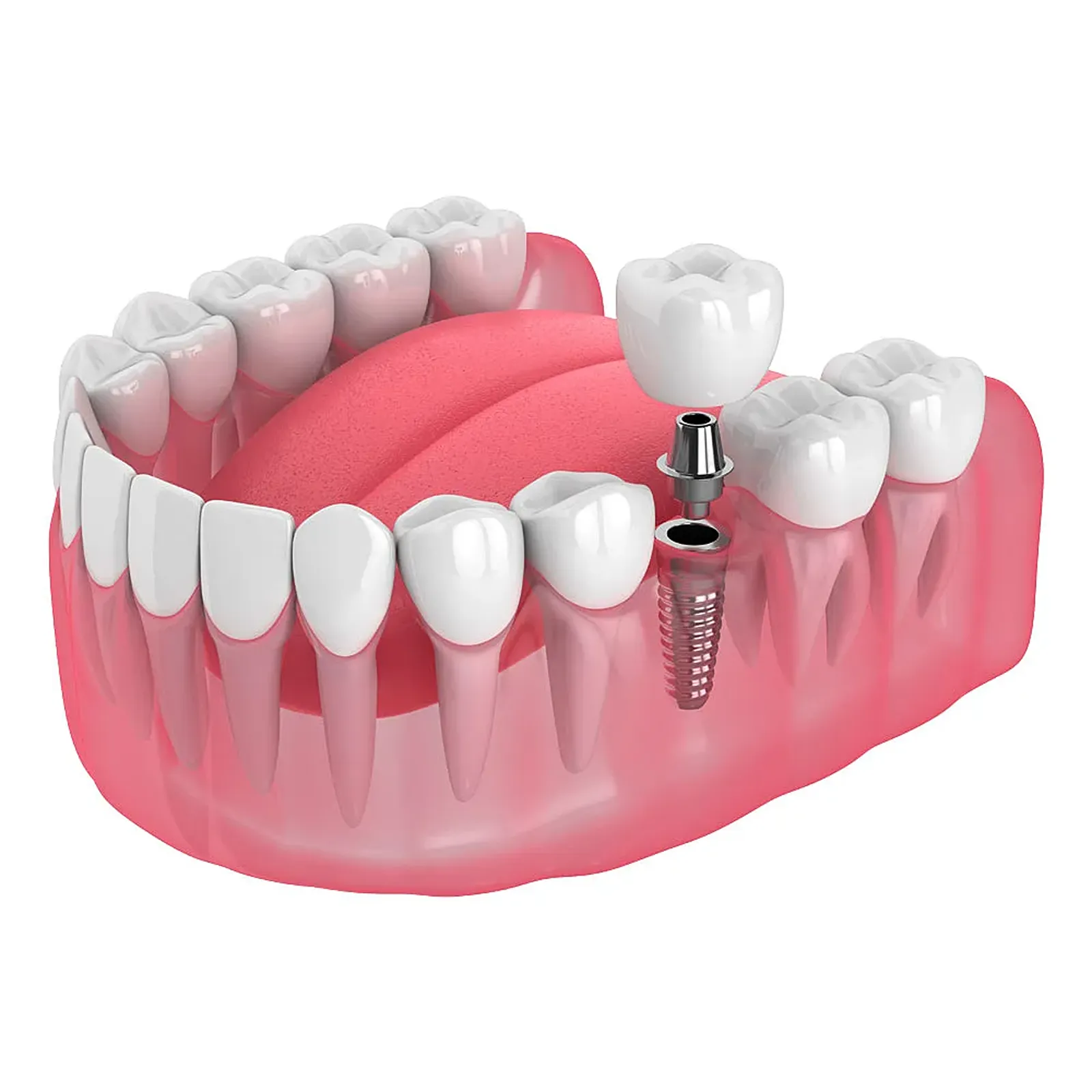 Single tooth dental implant