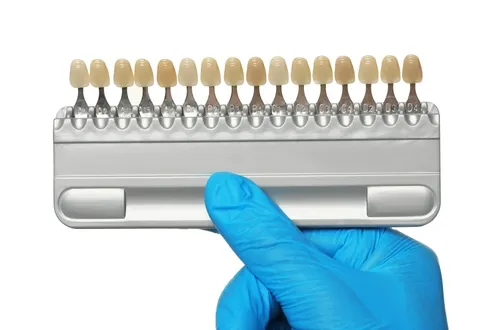 Composite veneers