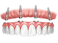 Implant-supported fixed-in dentures with New Teeth in One Day