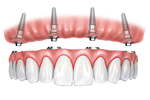 Dentures that snap onto implants.
