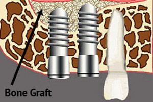 diagram of bone graft.