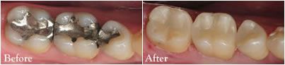 Tooth fillings, before and after.