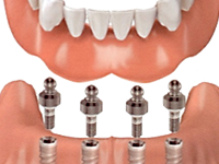 Implants to stabilize a current denture