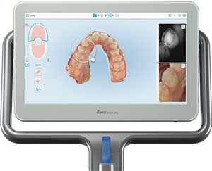 iTero Element 5D II intraoral scanner