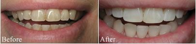 Before and after photo of teeth whitening case.